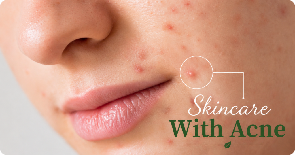 what is skin care with  acne :