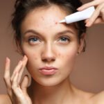 Skincare With Acne The Complete Solution Guide (2026)