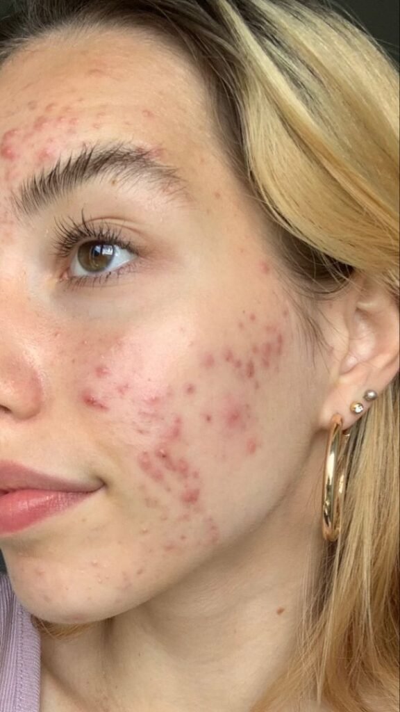  hormonal health :dermatological advice for hormonal acne